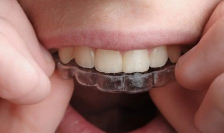 Soñar con enderezar los dientes : 16 significado y simbolismo