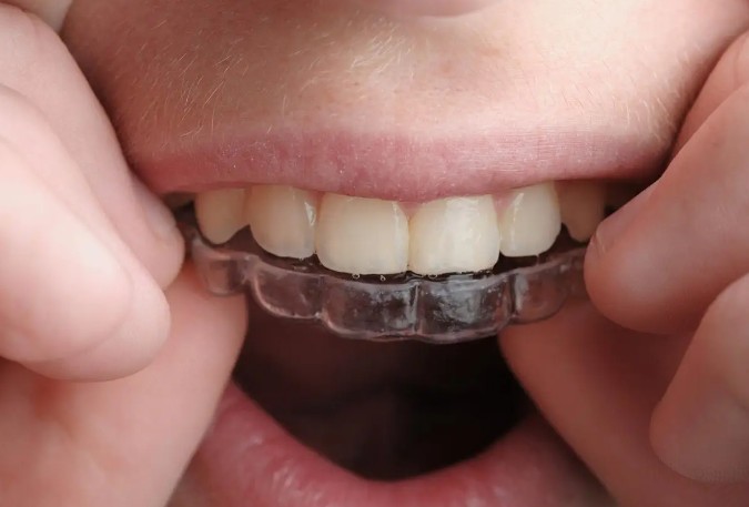 Soñar con enderezar los dientes : 16 significado y simbolismo