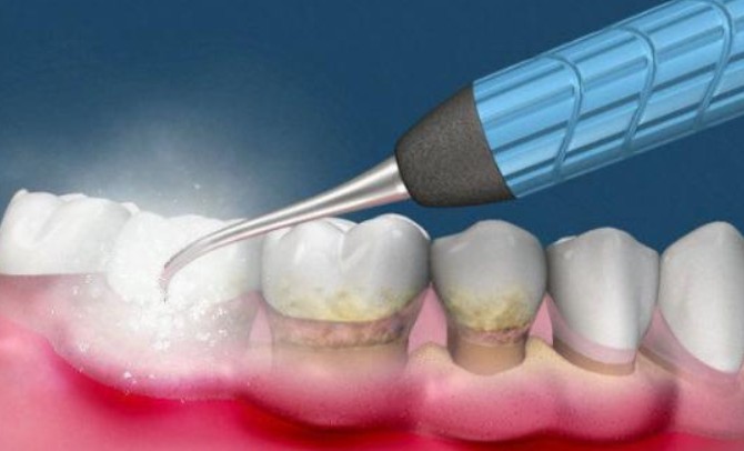 Soñar con la limpieza dental : 12 significado y simbolismo