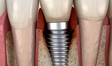 Soñar con implantes dentales : 18 significado y simbolismo