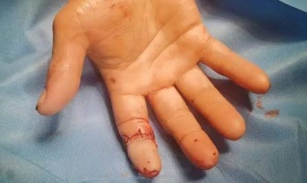 Soñar con un dedo roto : 24 significado y simbolismo