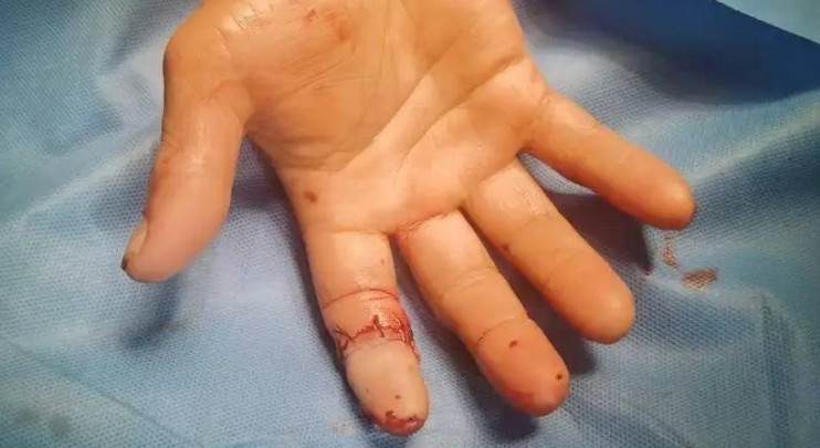 Soñar con un dedo roto : 24 significado y simbolismo