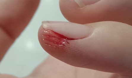 Soñar con una mano lesionada : 22 significado y simbolismo