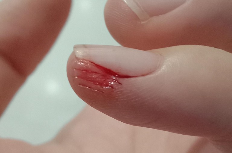 Soñar con una mano lesionada : 22 significado y simbolismo