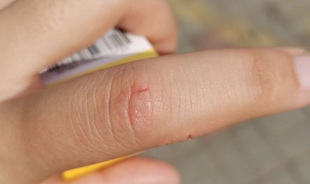 Soñar con un dedo lesionado : 28 significado y simbolismo