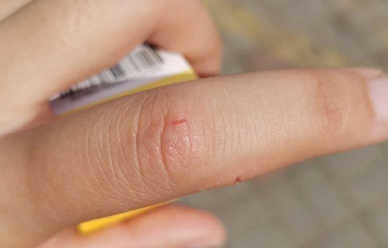 Soñar con un dedo lesionado : 28 significado y simbolismo