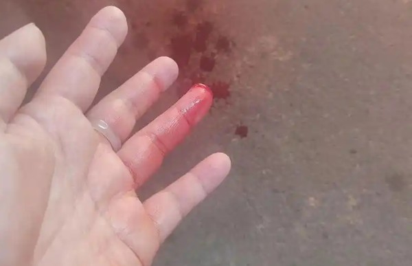 Soñar con que te cortan un dedo : 30 significado y simbolismo