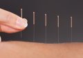 21 Significados de Soñar con una Clínica de Acupuntura
