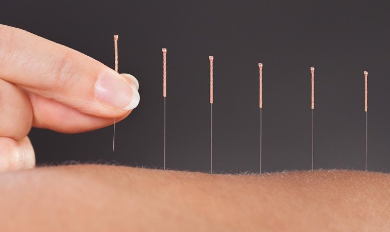 21 Significados de Soñar con una Clínica de Acupuntura